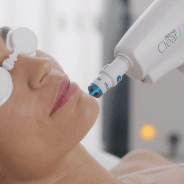 Ultimate Clearlift Facial 4txs